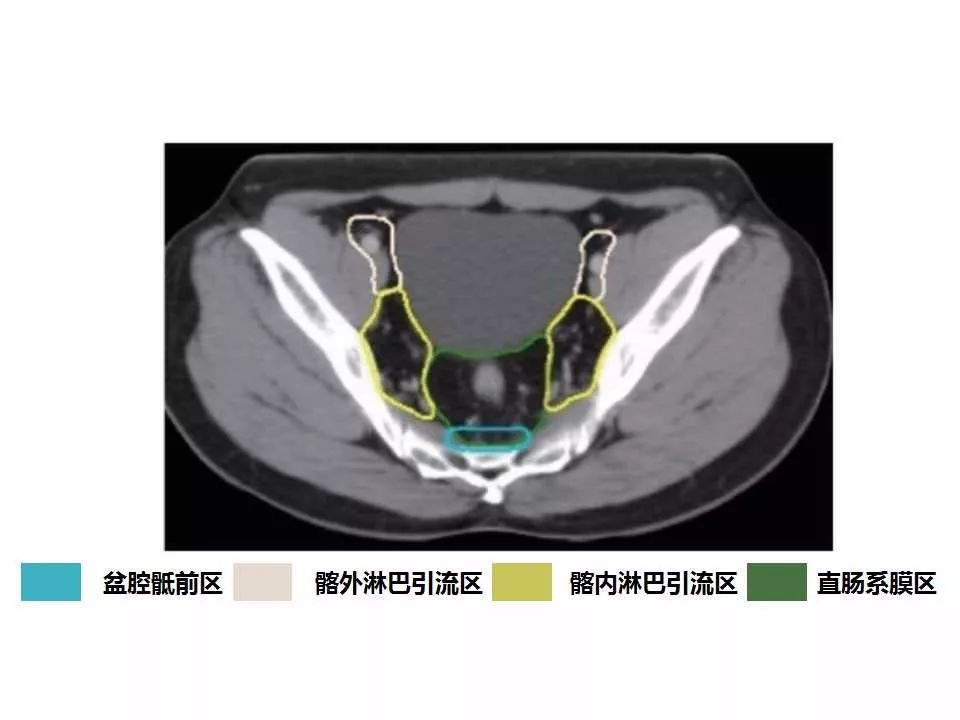 影像PPT - 直肠癌淋巴引流区图谱-23