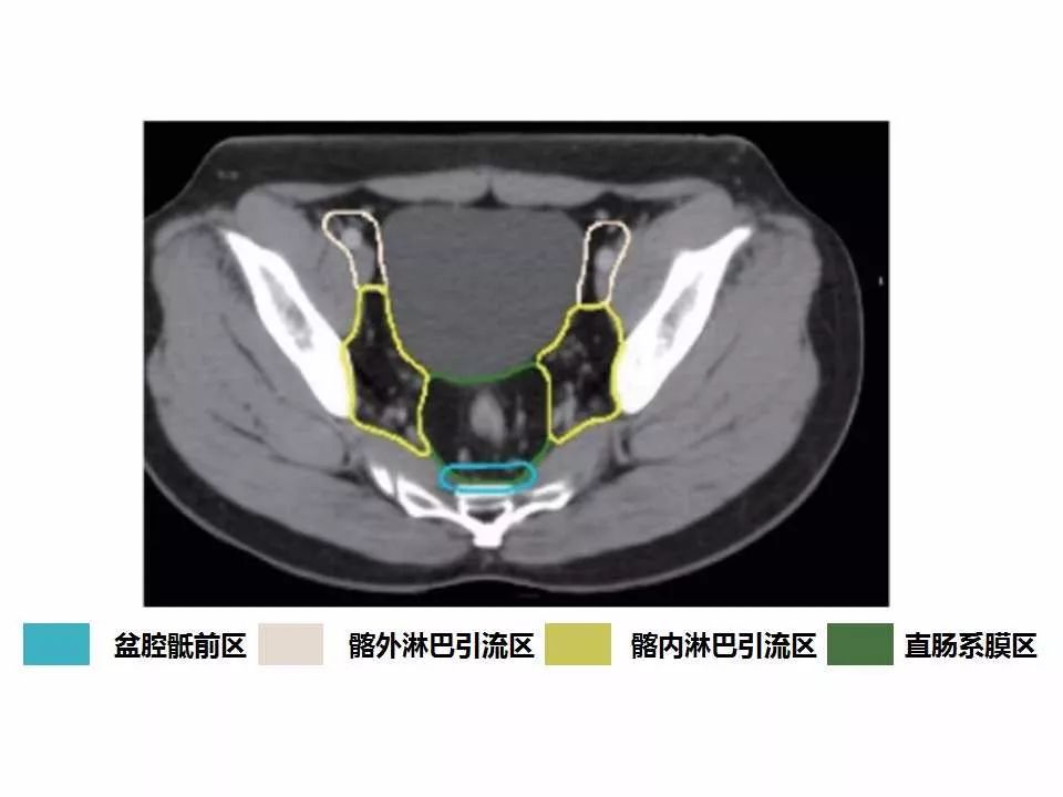 影像PPT - 直肠癌淋巴引流区图谱-24