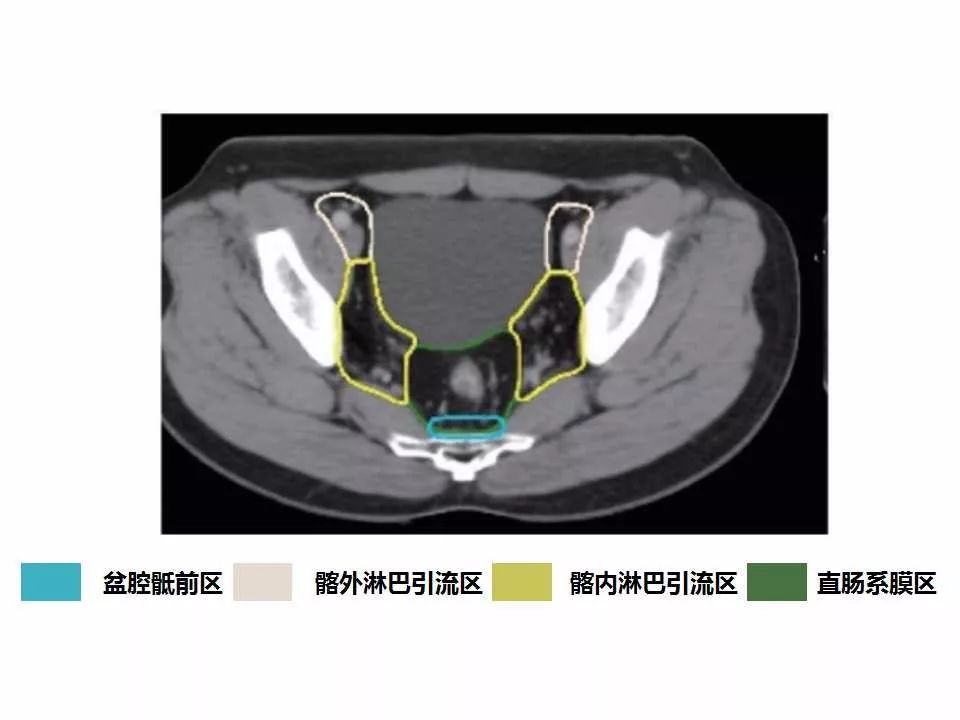 影像PPT - 直肠癌淋巴引流区图谱-25