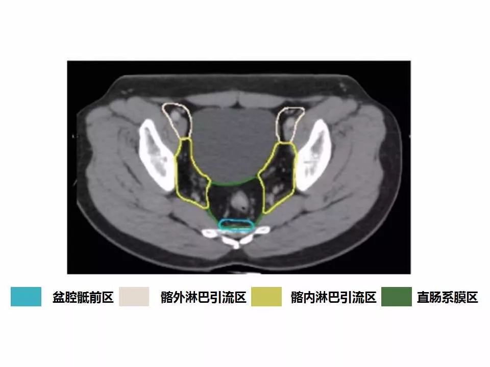 影像PPT - 直肠癌淋巴引流区图谱-26
