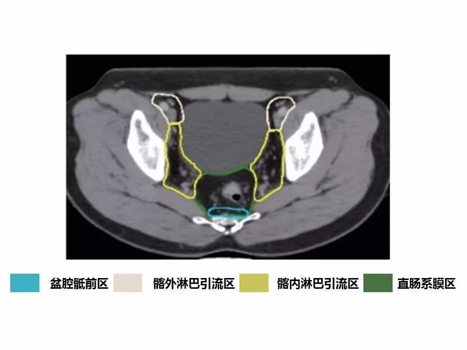 影像PPT - 直肠癌淋巴引流区图谱-27