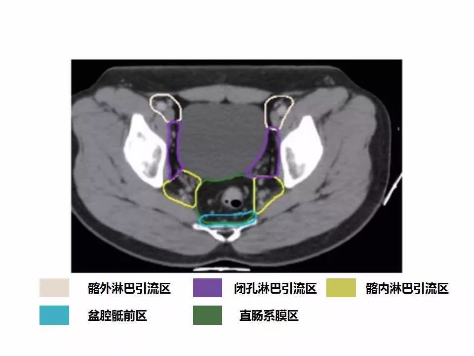 影像PPT - 直肠癌淋巴引流区图谱-28