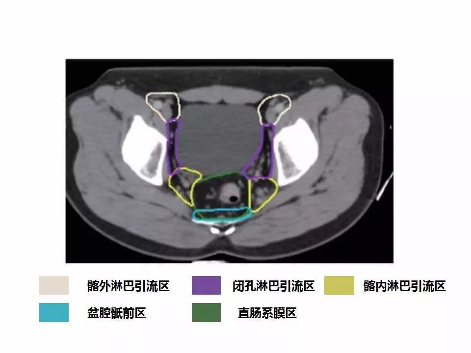 影像PPT - 直肠癌淋巴引流区图谱-29