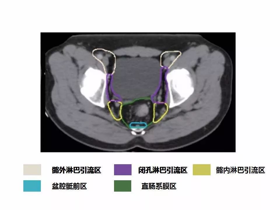 影像PPT - 直肠癌淋巴引流区图谱-30