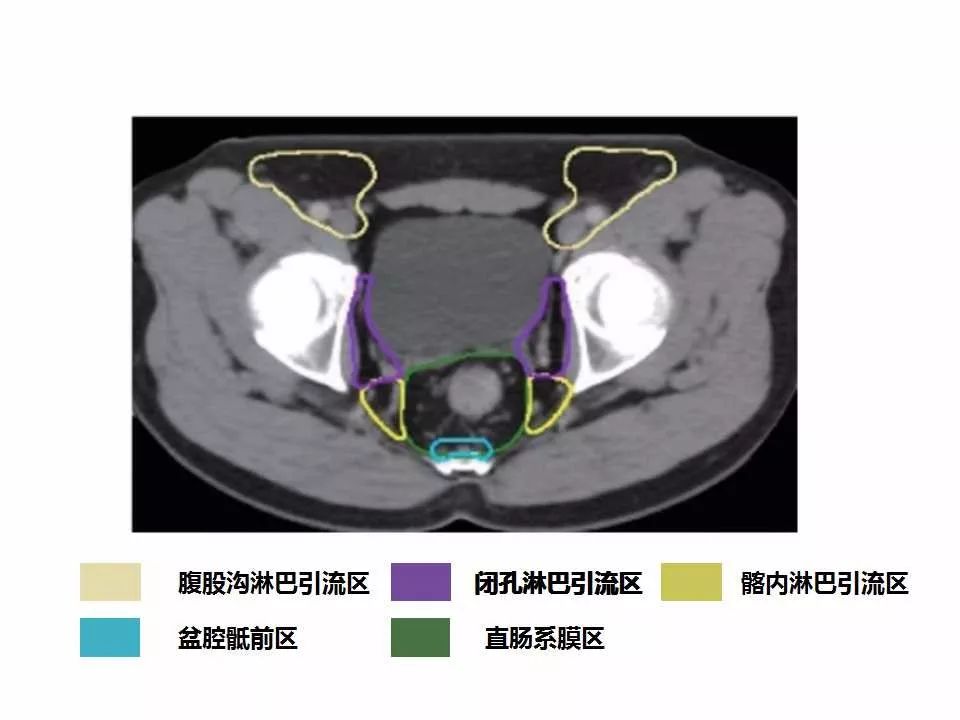 影像PPT - 直肠癌淋巴引流区图谱-31