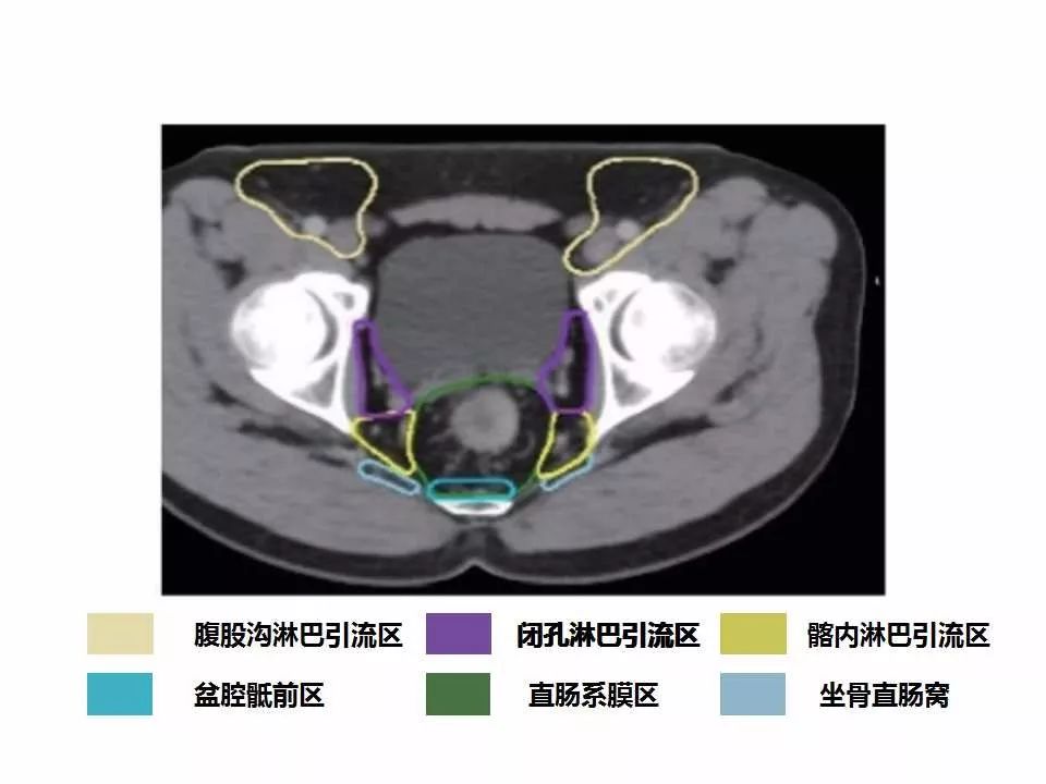 影像PPT - 直肠癌淋巴引流区图谱-32