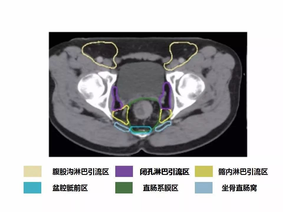 影像PPT - 直肠癌淋巴引流区图谱-33