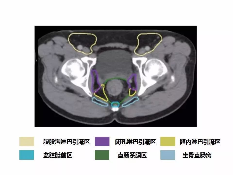 影像PPT - 直肠癌淋巴引流区图谱-34