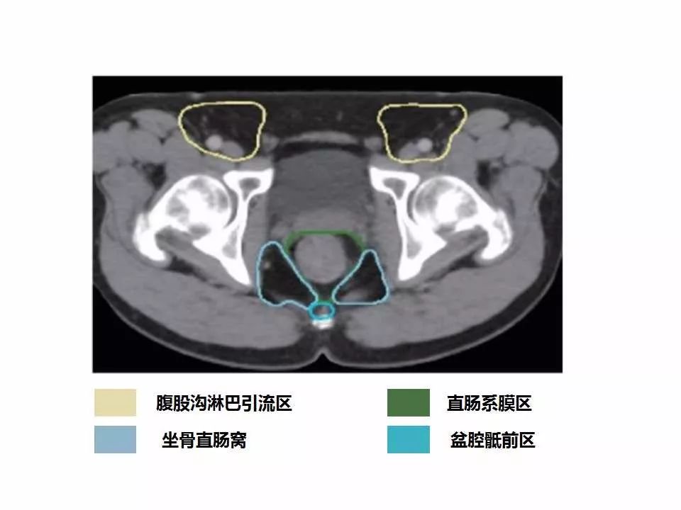 影像PPT - 直肠癌淋巴引流区图谱-35