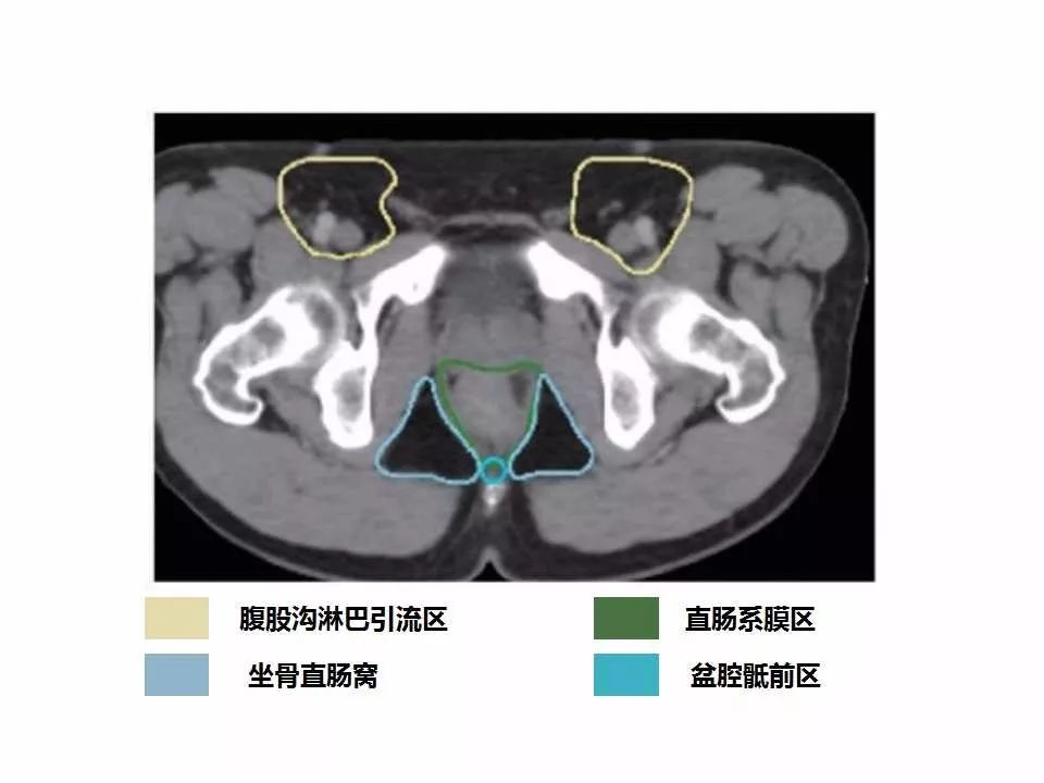 影像PPT - 直肠癌淋巴引流区图谱-36