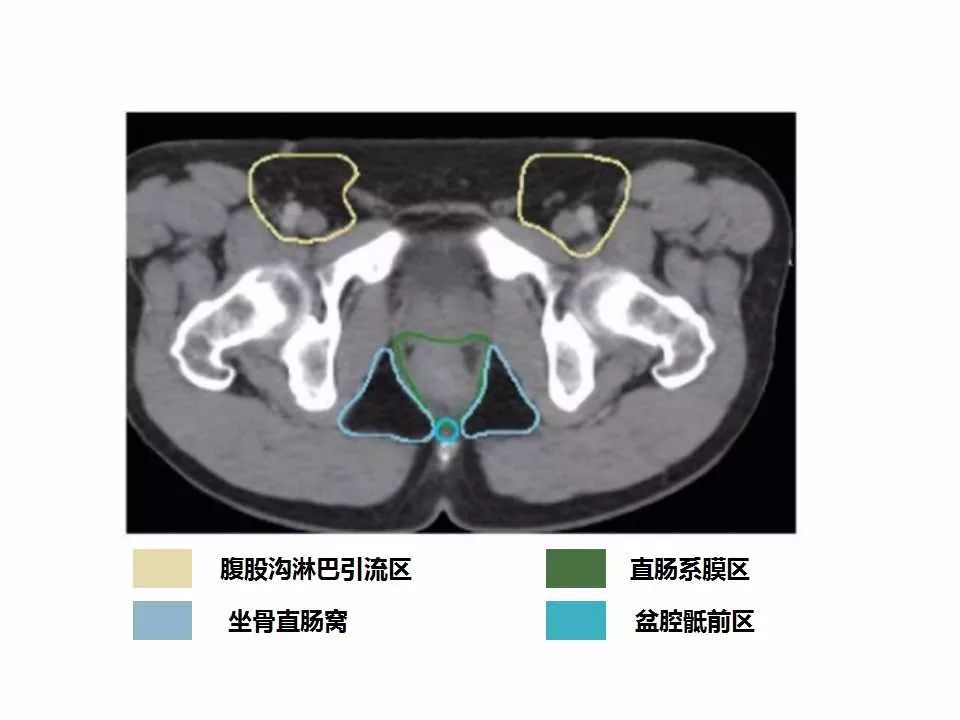 影像PPT - 直肠癌淋巴引流区图谱-37