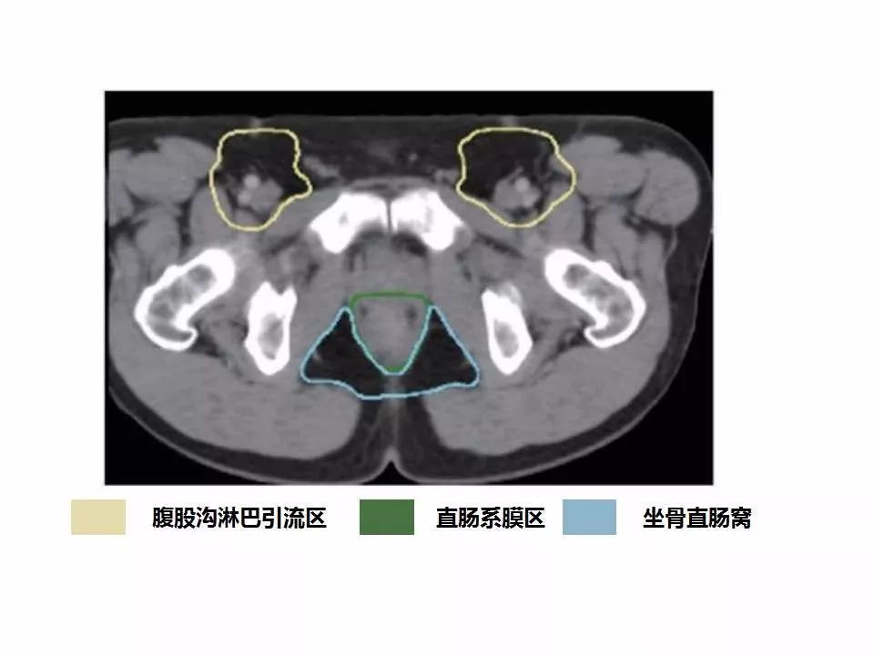影像PPT - 直肠癌淋巴引流区图谱-38