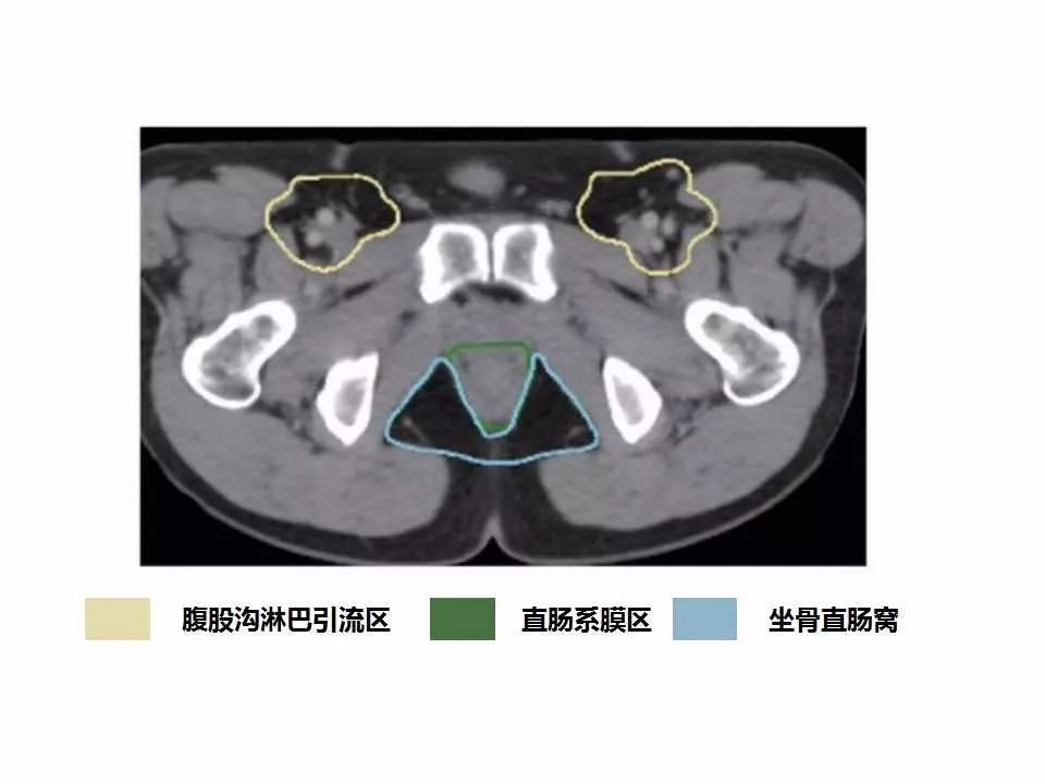 影像PPT - 直肠癌淋巴引流区图谱-39
