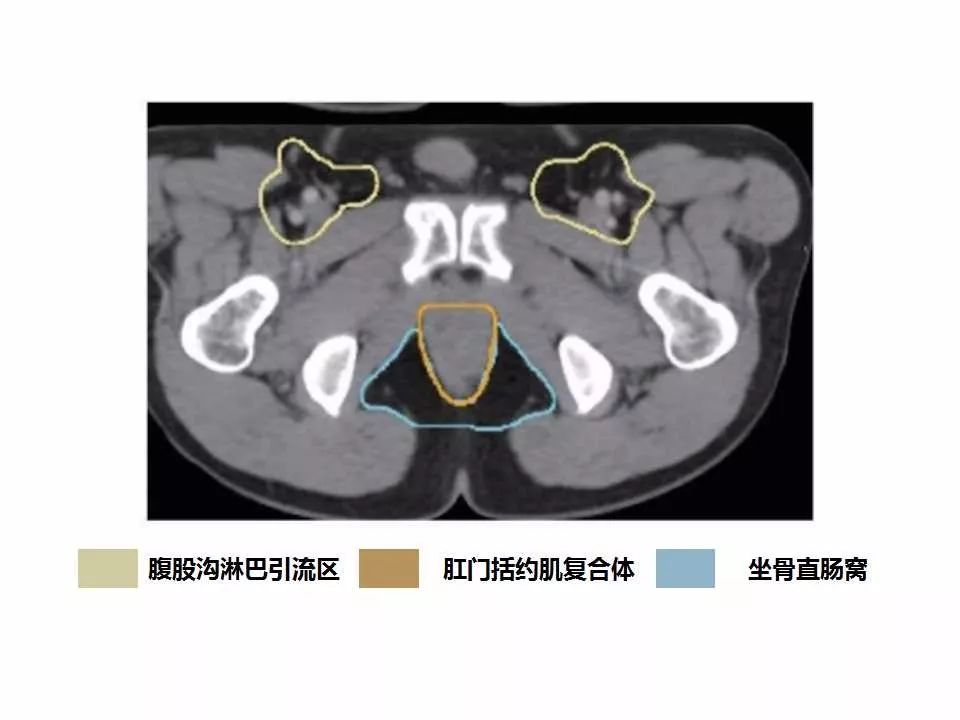 影像PPT - 直肠癌淋巴引流区图谱-40