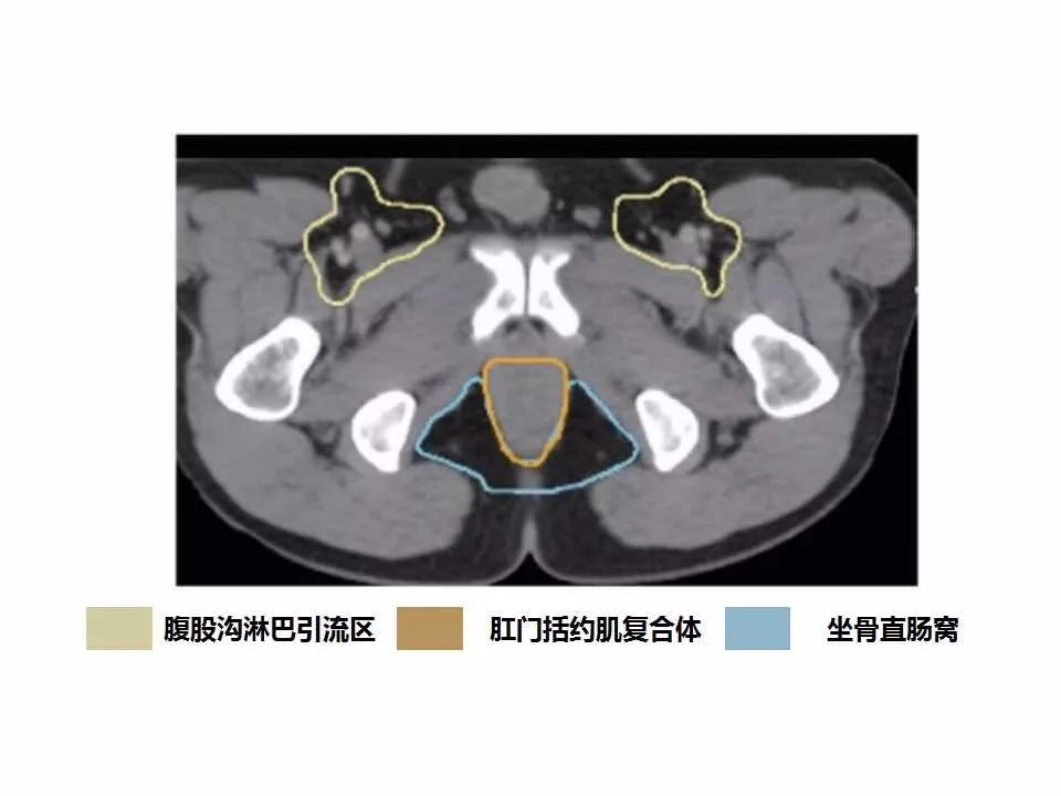 影像PPT - 直肠癌淋巴引流区图谱-41