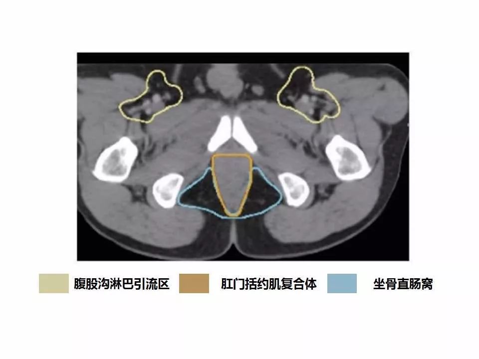 影像PPT - 直肠癌淋巴引流区图谱-42