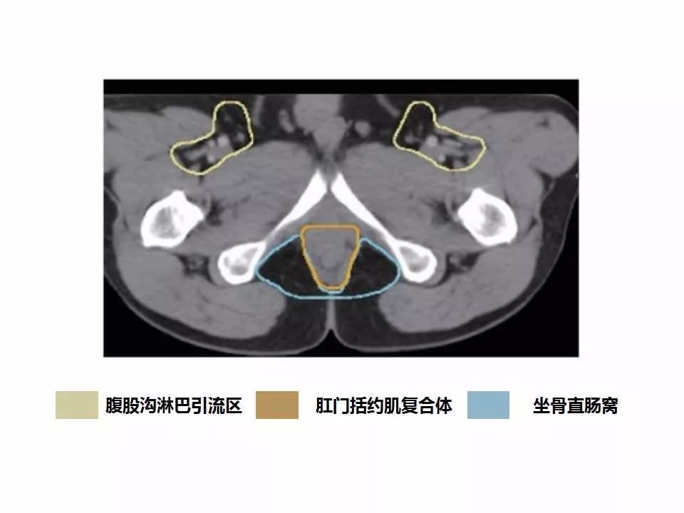 影像PPT - 直肠癌淋巴引流区图谱-43