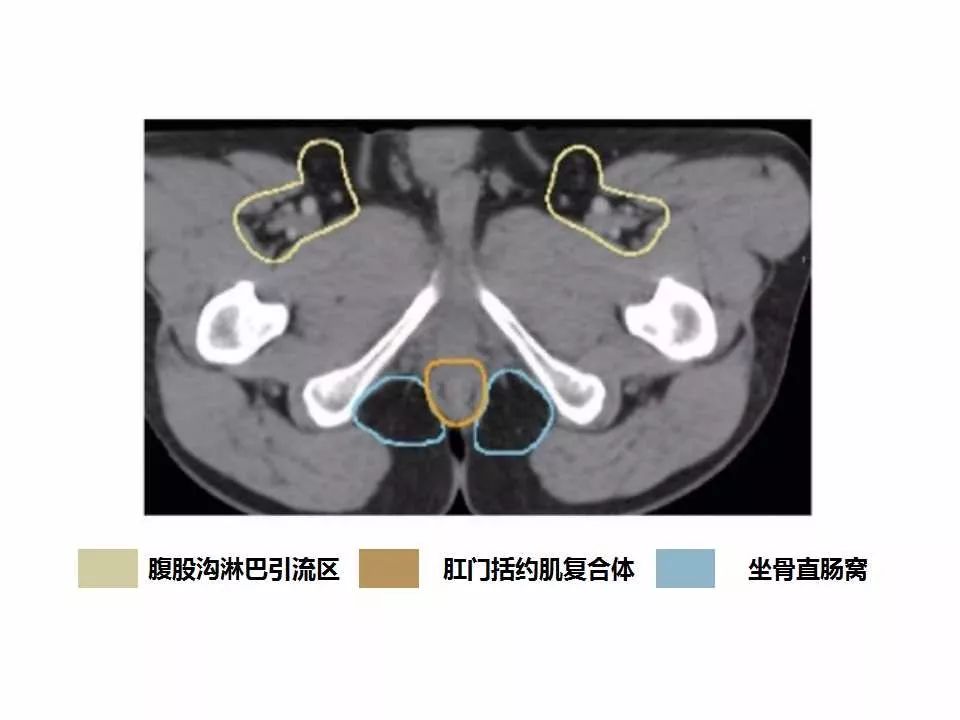 影像PPT - 直肠癌淋巴引流区图谱-44