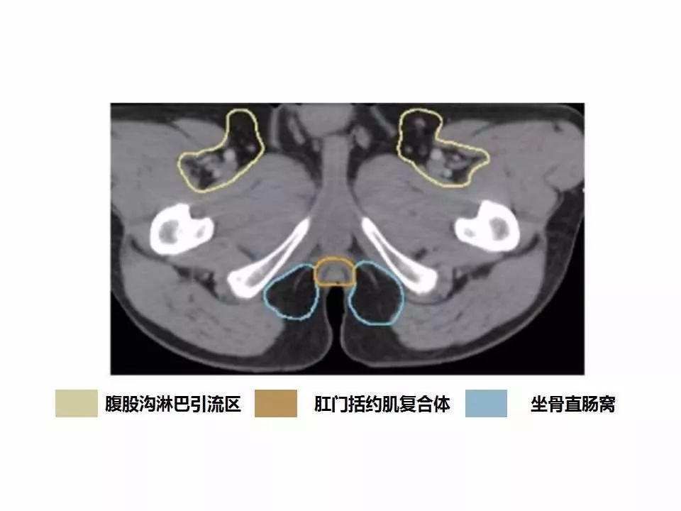 影像PPT - 直肠癌淋巴引流区图谱-45