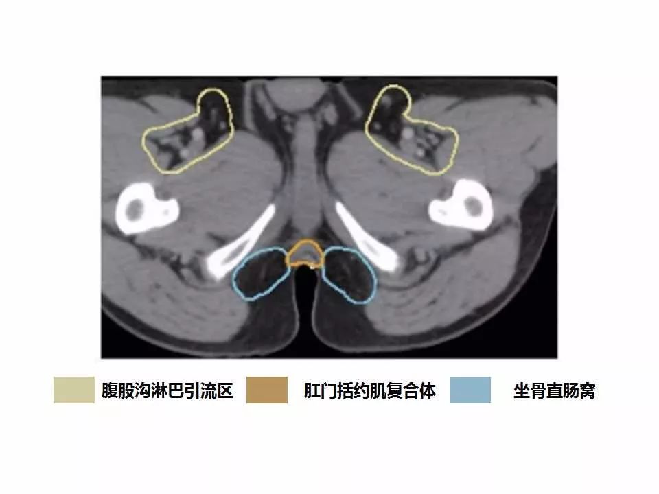 影像PPT - 直肠癌淋巴引流区图谱-46