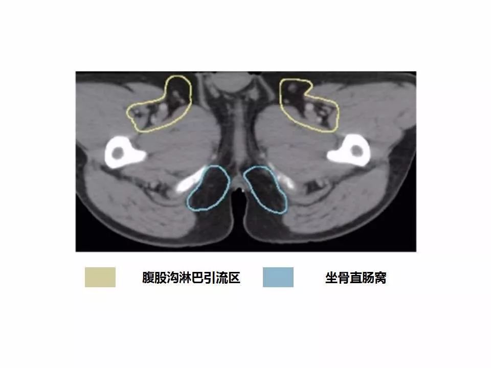 影像PPT - 直肠癌淋巴引流区图谱-47
