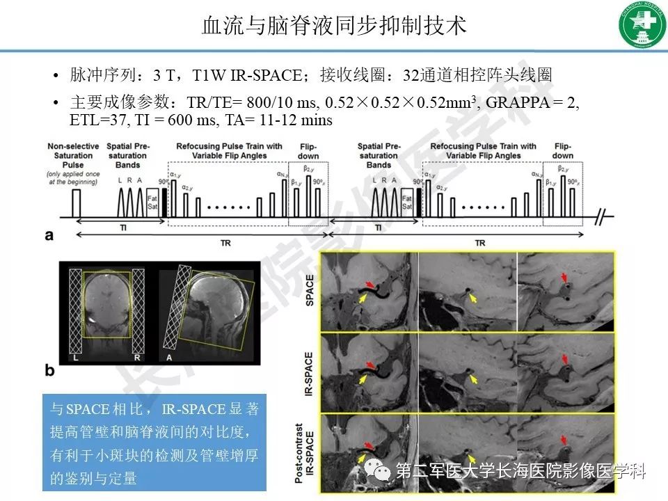 影像PPT - 【PPT】头颈部磁共振血管壁成像技术进展-23