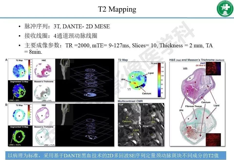 影像PPT - 【PPT】头颈部磁共振血管壁成像技术进展-33