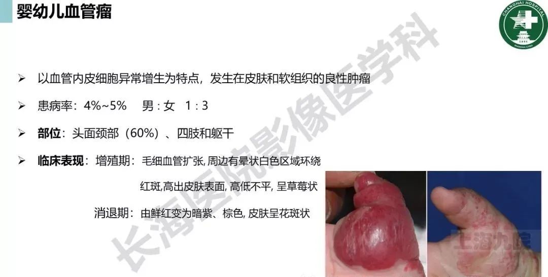 影像PPT - 【PPT】婴幼儿血管瘤与静脉畸形-8