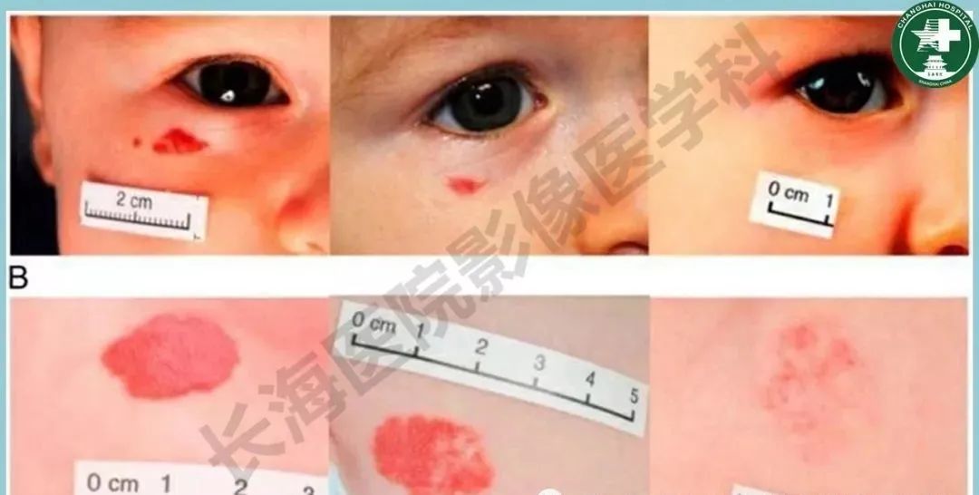 影像PPT - 【PPT】婴幼儿血管瘤与静脉畸形-17