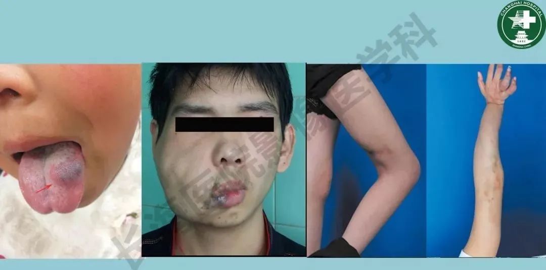 影像PPT - 【PPT】婴幼儿血管瘤与静脉畸形-22