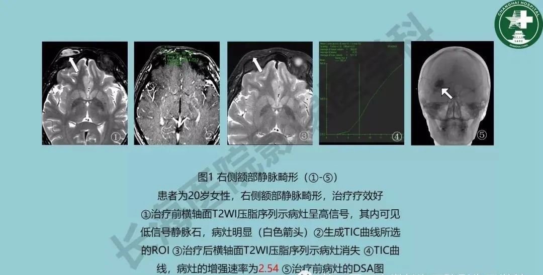 影像PPT - 【PPT】婴幼儿血管瘤与静脉畸形-29