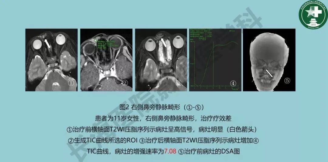 影像PPT - 【PPT】婴幼儿血管瘤与静脉畸形-30