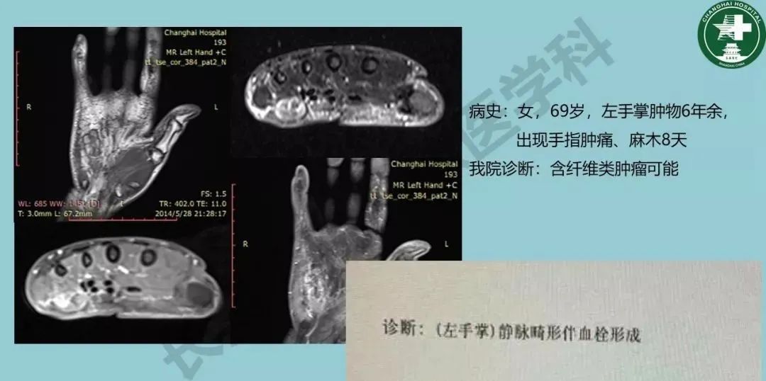 影像PPT - 【PPT】婴幼儿血管瘤与静脉畸形-37