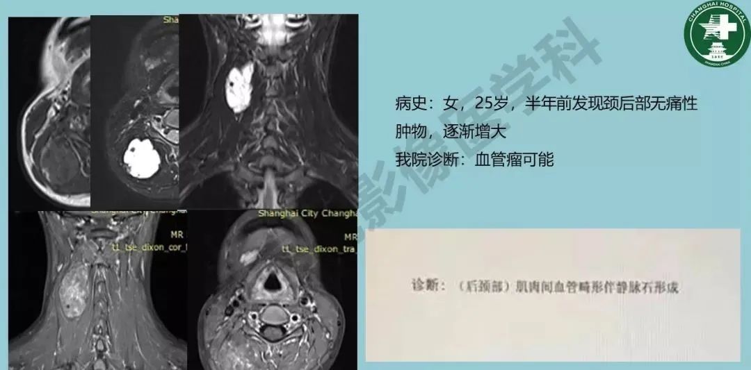 影像PPT - 【PPT】婴幼儿血管瘤与静脉畸形-38