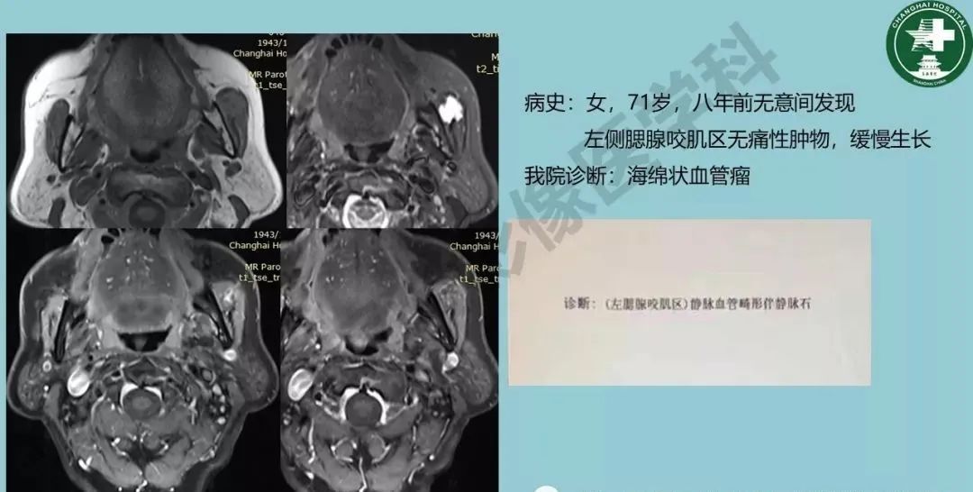 影像PPT - 【PPT】婴幼儿血管瘤与静脉畸形-39