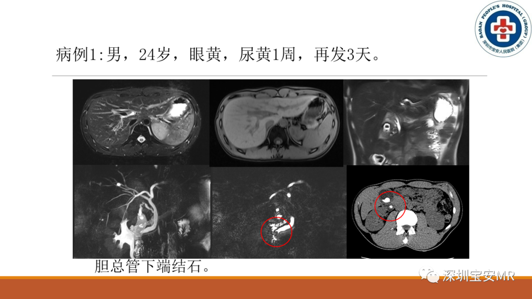 影像PPT - 【PPT】壶腹部病变影像分析-8