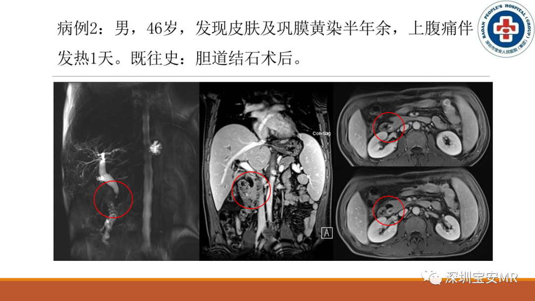 影像PPT - 【PPT】壶腹部病变影像分析-9