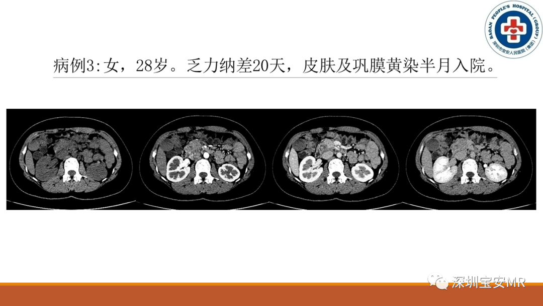 影像PPT - 【PPT】壶腹部病变影像分析-10