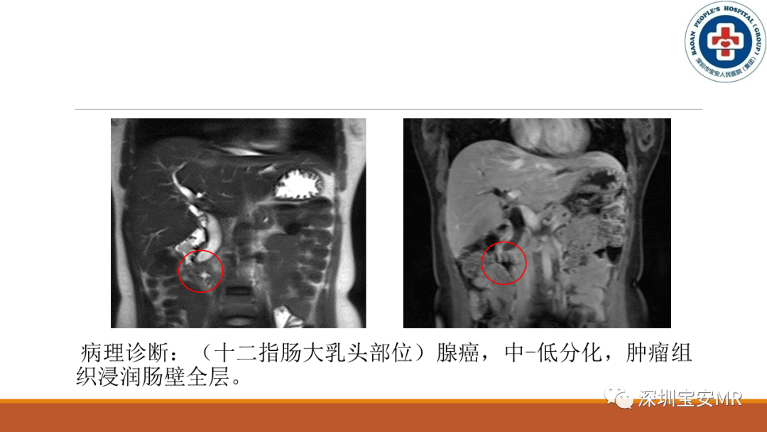 影像PPT - 【PPT】壶腹部病变影像分析-12