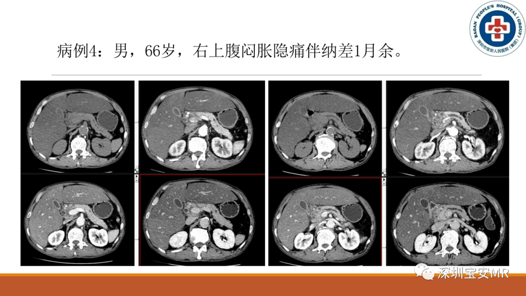 影像PPT - 【PPT】壶腹部病变影像分析-14