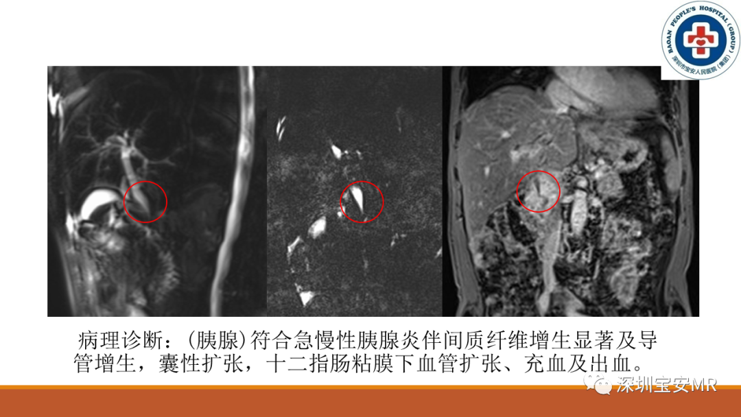 影像PPT - 【PPT】壶腹部病变影像分析-17