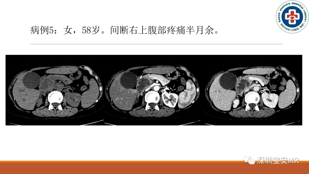 影像PPT - 【PPT】壶腹部病变影像分析-18