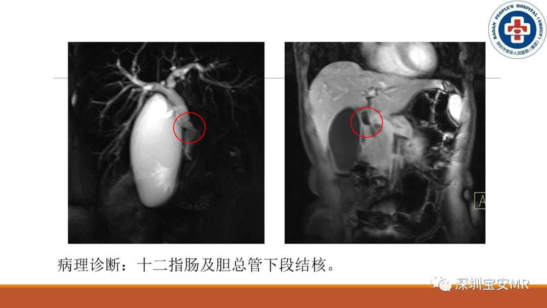 影像PPT - 【PPT】壶腹部病变影像分析-21
