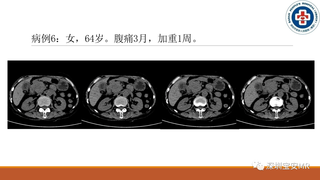 影像PPT - 【PPT】壶腹部病变影像分析-22