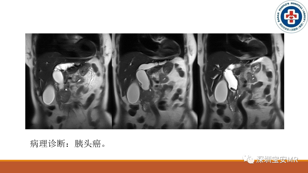 影像PPT - 【PPT】壶腹部病变影像分析-24