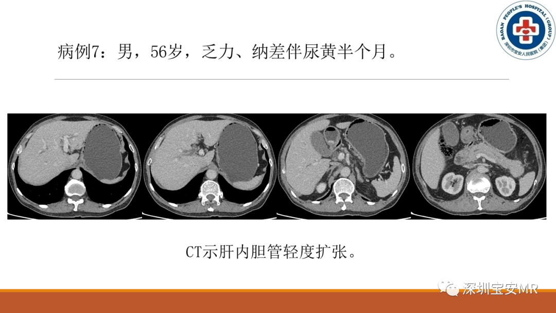 影像PPT - 【PPT】壶腹部病变影像分析-26