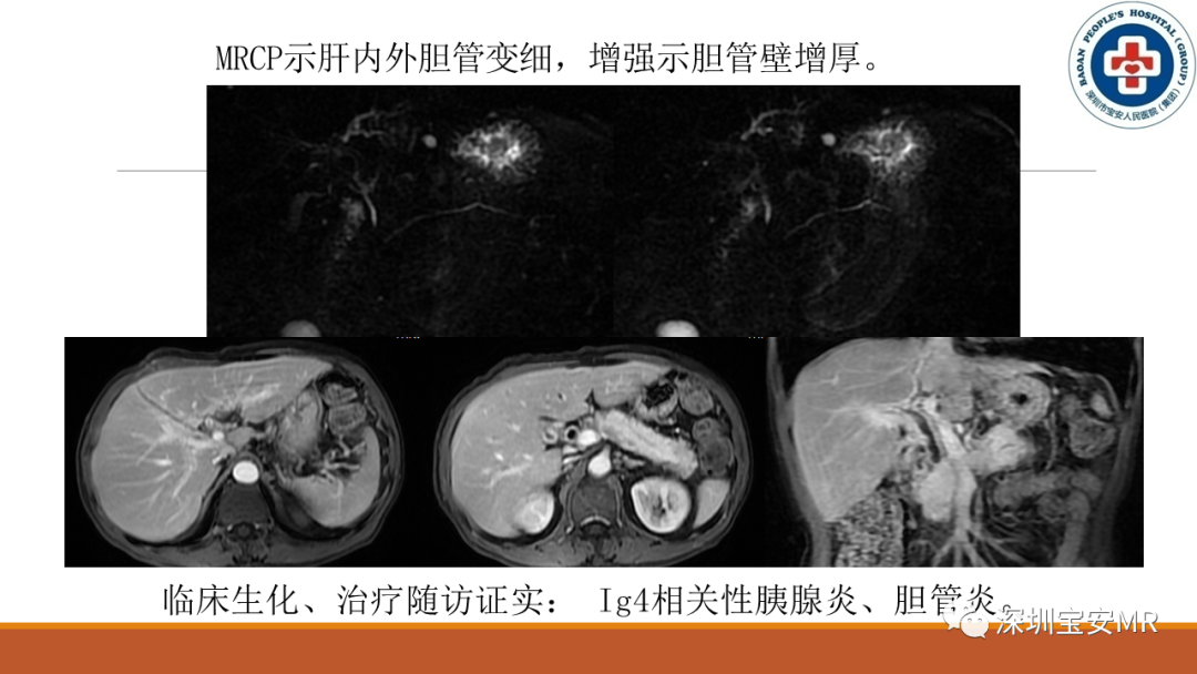 影像PPT - 【PPT】壶腹部病变影像分析-28