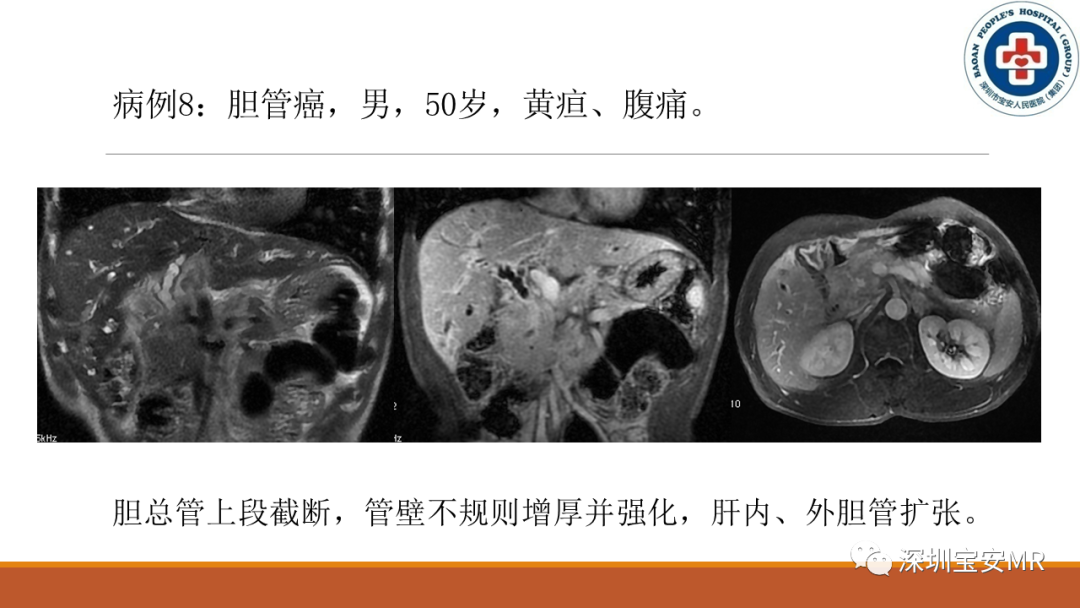 影像PPT - 【PPT】壶腹部病变影像分析-29