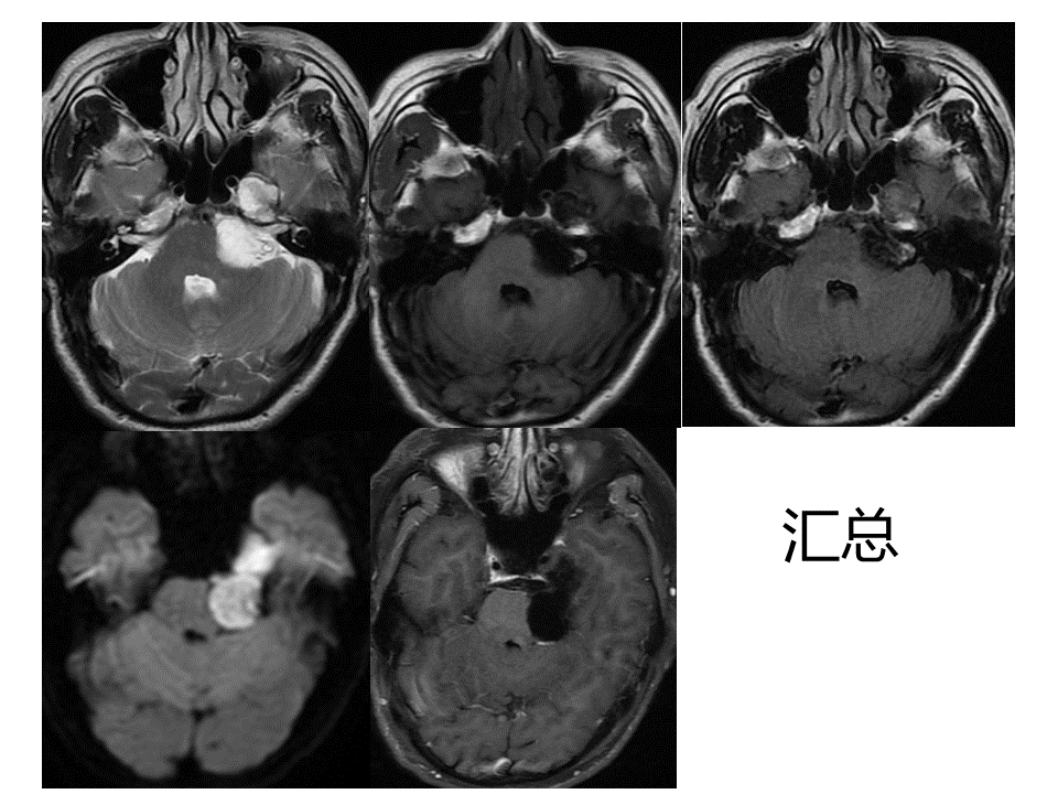 影像PPT - 【病例】桥小脑角区神经鞘瘤 VS 表皮样囊肿(胆脂瘤)-14