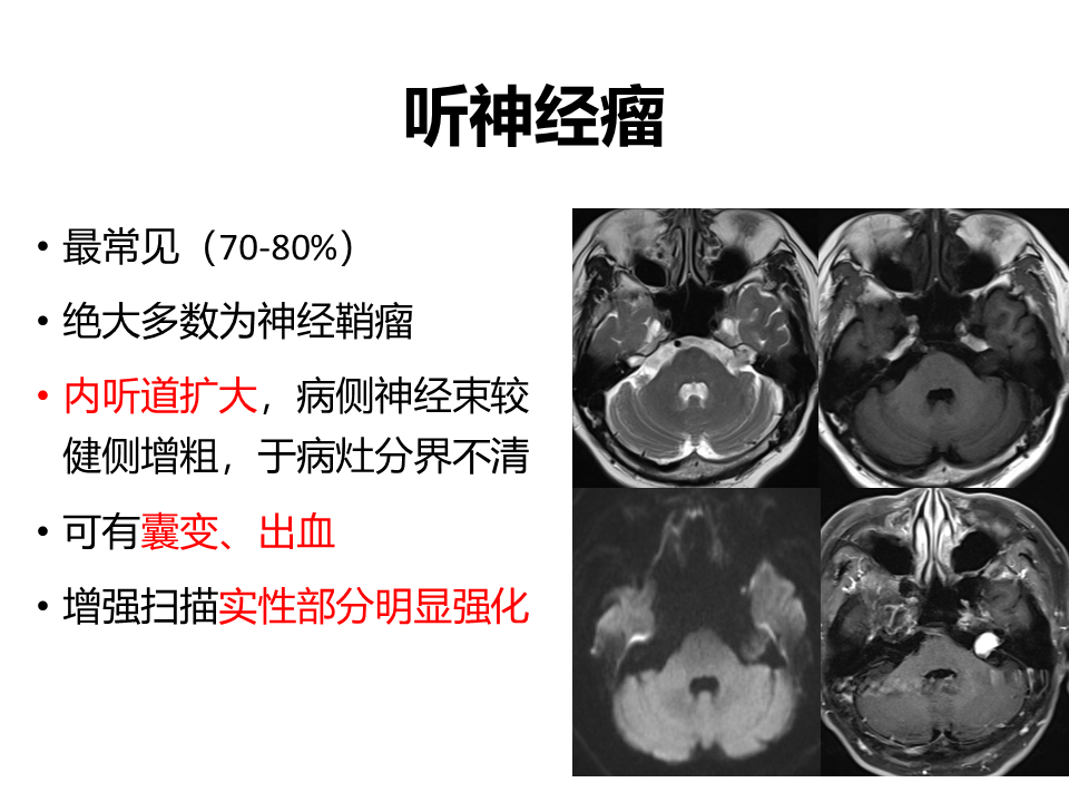 影像PPT - 【病例】桥小脑角区神经鞘瘤 VS 表皮样囊肿(胆脂瘤)-20